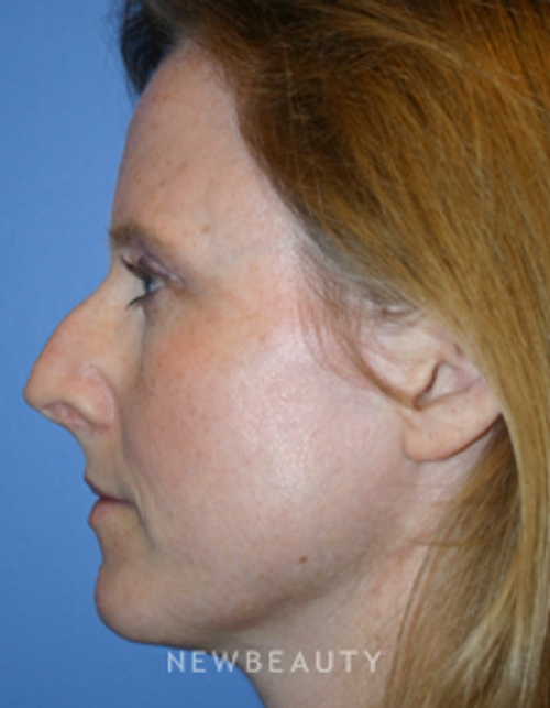 Dr. Kelly Bomer, Rhinoplasty - Before