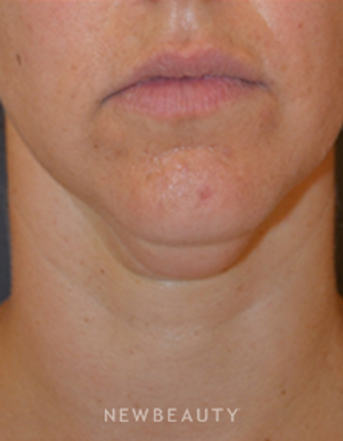 Dr. Aviva Preminger - Kybella - Before