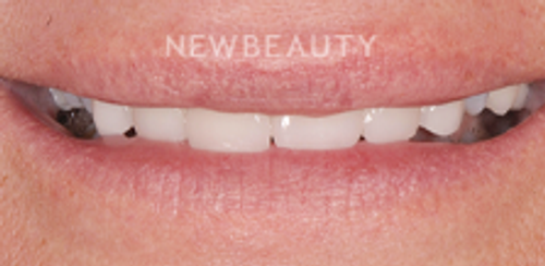 Dr. Salvator La Mastra - Smile Makeover -46106655 - Before
