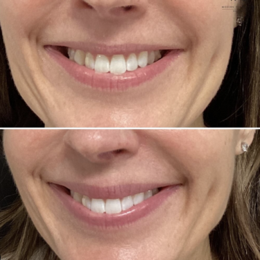 lip flip before and after using Botox for a subtle result