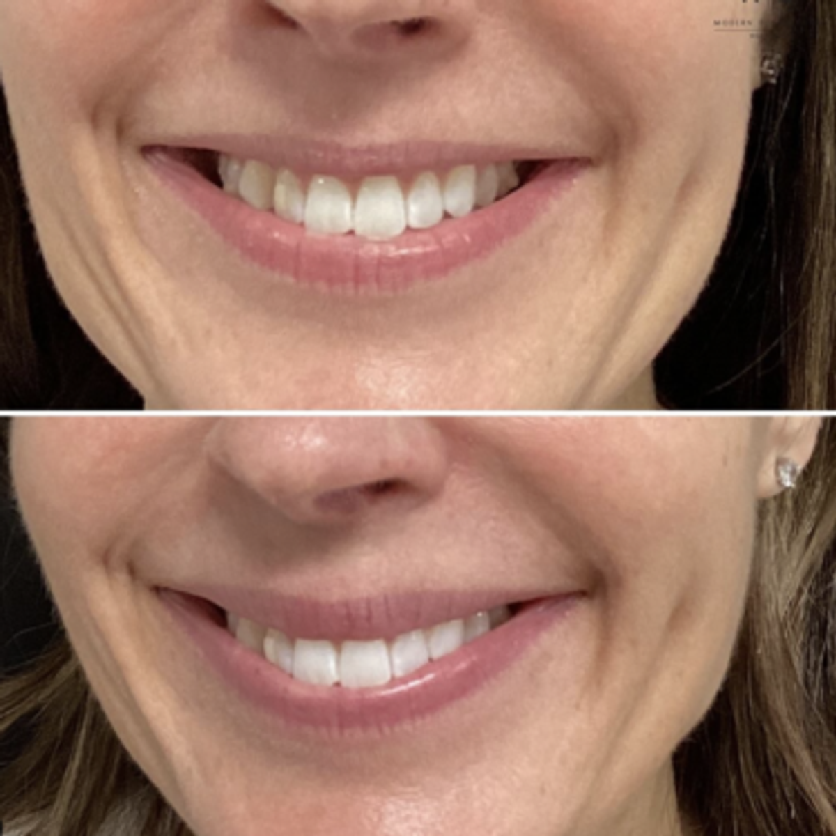 lip flip before and after using Botox for a subtle result