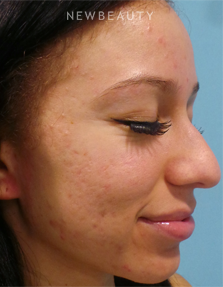 Dr. Sean Simon - Fresh and Clear Skin - Before
