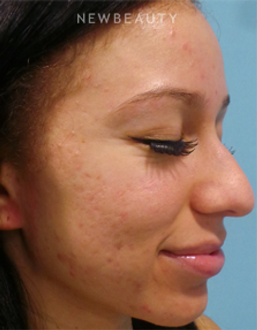 Dr. Sean Simon - Fresh and Clear Skin - Before