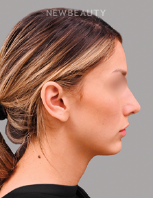 Dr. Shahin Fazilat - Rhinoplasty - 46267418 - After