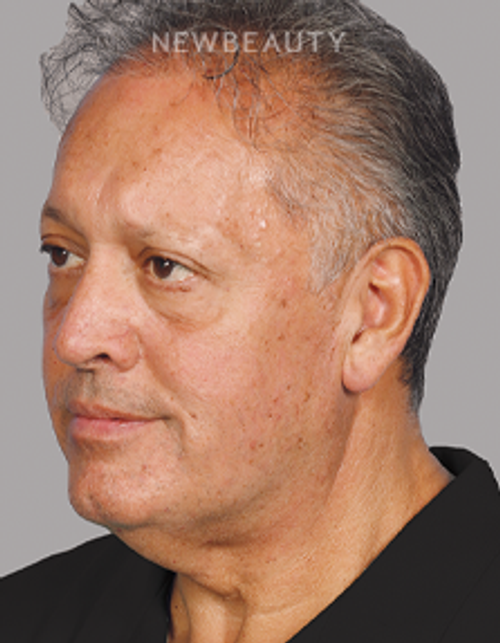 Dr. Kurtovic - Breast Lift - 20637640 - Before