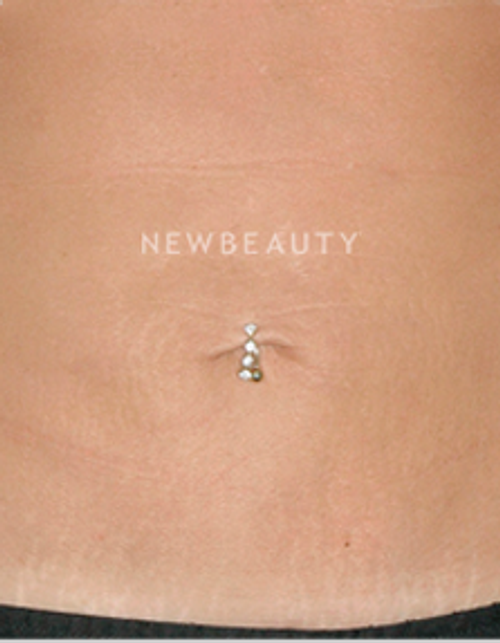 Dr. Ruth Hillelson Skin Resurfacing - After