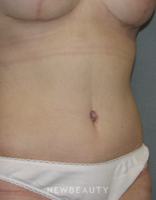 Dr. Sean Simon Breast Augmentation, Breast Lift, Liposuction, Tummy Tuck - After