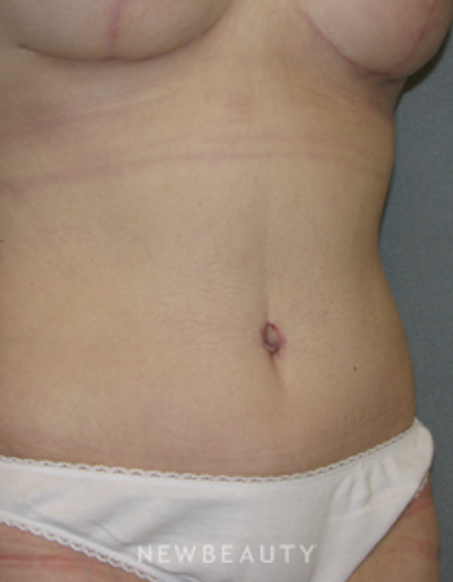 Dr. Sean Simon Breast Augmentation, Breast Lift, Liposuction, Tummy Tuck - After