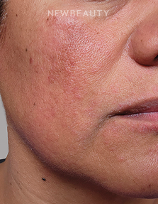 Dr. Anna Chacon - Melasma - 34291235 - Before
