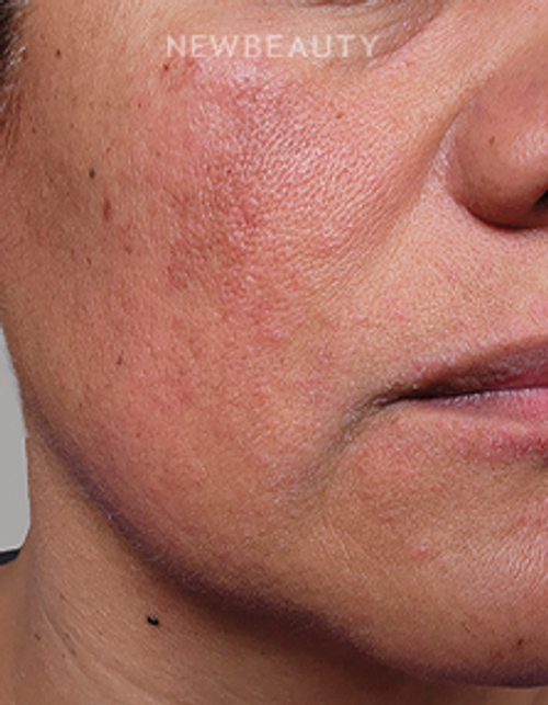 Dr. Anna Chacon - Melasma - 34291235 - Before