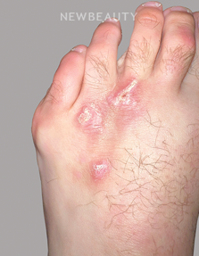 Dr. Anna Chacon - Skin Lesion - 34279276 - Before