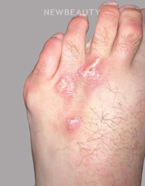 Dr. Anna Chacon - Skin Lesion - 34279276 - Before