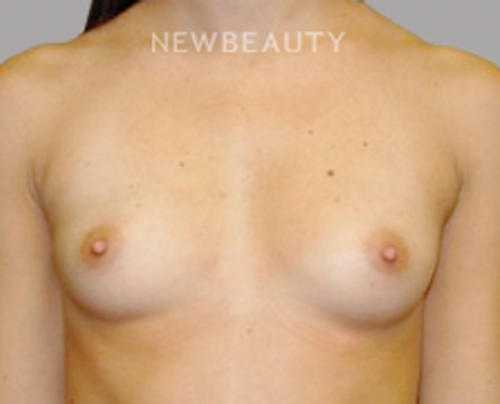 Dr. Sanjay Grover - Breast Augmentation - 49713238 - Before