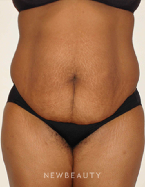 Dr. Michael Horn Tummy Tuck - Before