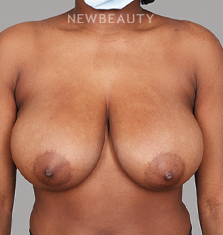 Dr. Chet Mays - Breast Reduction and Lift - 35050414 - Before