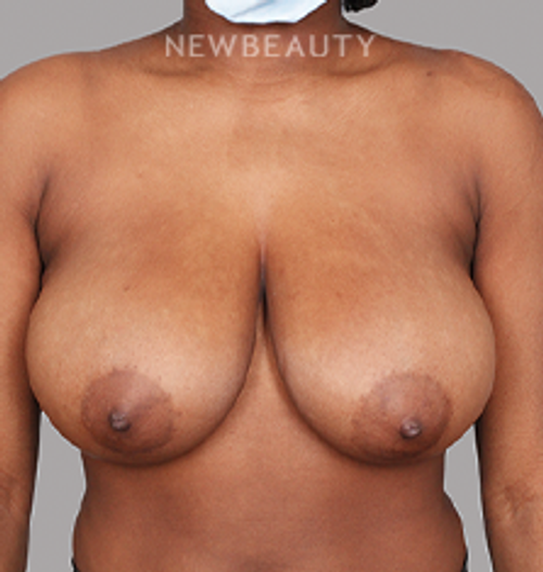 Dr. Chet Mays - Breast Reduction and Lift - 35050414 - Before