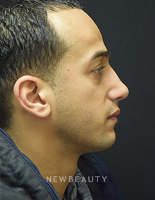 Dr. Jeffrey B. Wise - Rhinoplasty - After