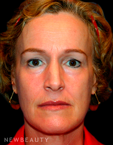 Dr. Kelly Bomer Facelift - Before