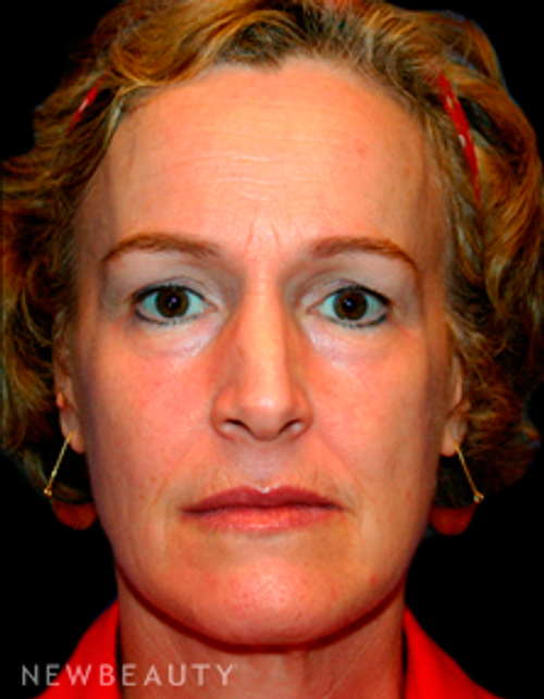 Dr. Kelly Bomer Facelift - Before