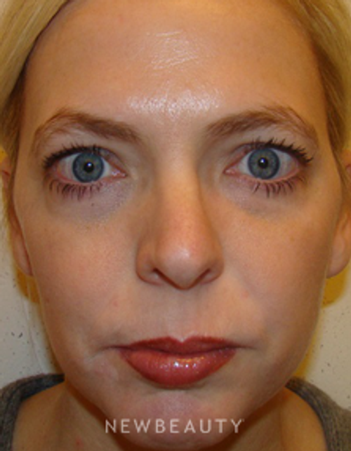 Dr. Joel Schlessinger - Dysport - After