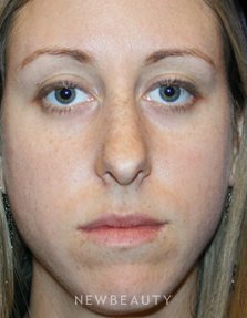Dr. Kelly Bomer Rhinoplasty - Before