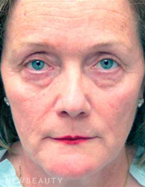 Dr. Mokhtar Asaadi Facelift - Before
