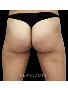 Dr. Julie Russak - Cellulite - After