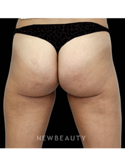 Dr. Julie Russak - Cellulite - After
