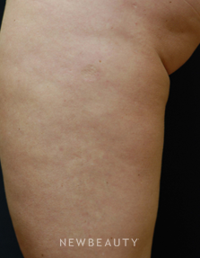 Dr. Kenneth Beer Lasers - Cellulite Treatment - After