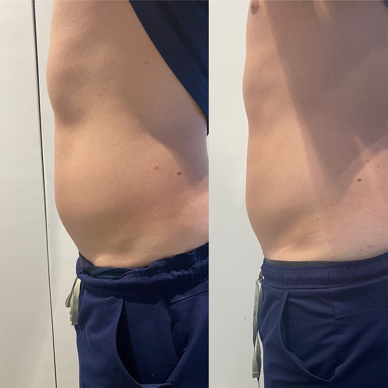 The Zero-Contact, Zero-Downtime Body-Sculpting Treatment You Need to Know About