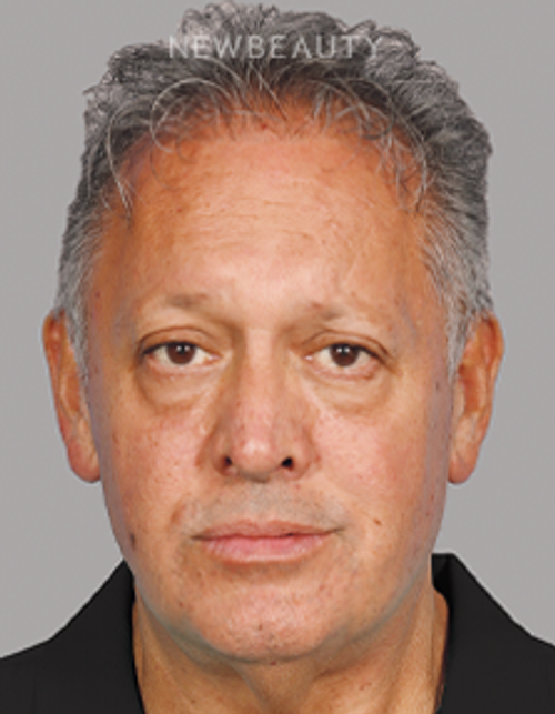 Dr. Kurtovic - Breast Lift - 20637640 - Before