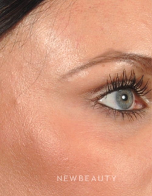 Dr. Bradley Bengtson - Periorbital Vessel Treatment - After