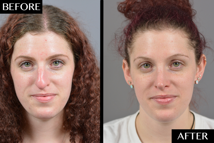 rhinoplasty1