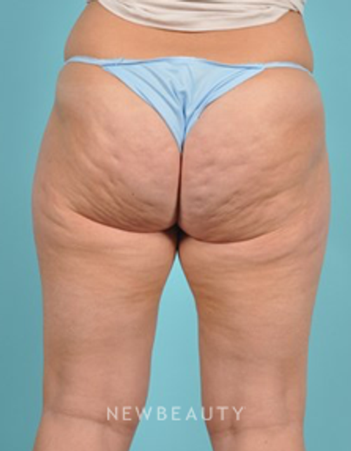 Dr. Brad Bengtson - Cellulite Treatment - Before
