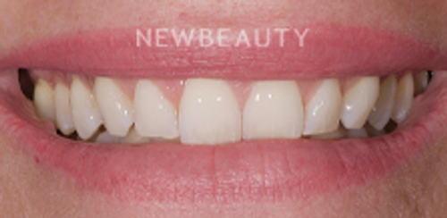 Dr. Salvator La Mastra - Smile Makeover -46107438 - Before