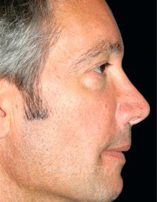 Dr. Kelly Bomer Injectables - Before