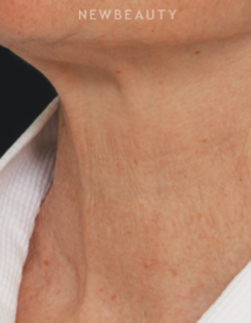 Drs. Jennifer Segal & Scott Smith - Microneedling - After