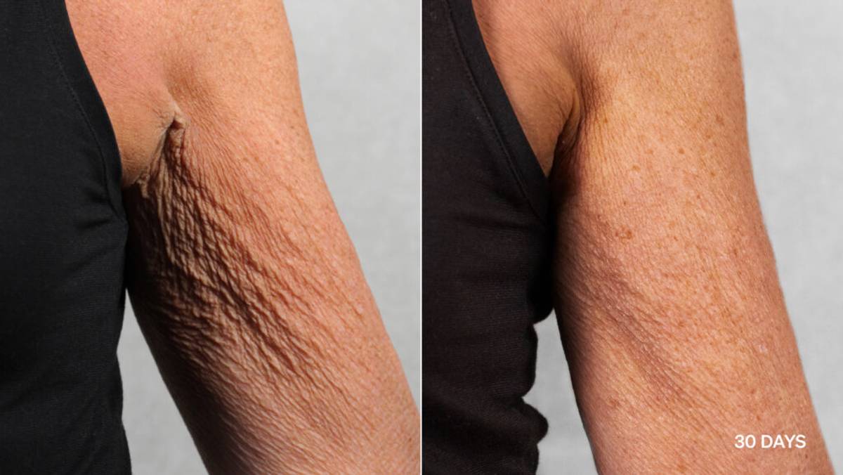 lyma laser pro results