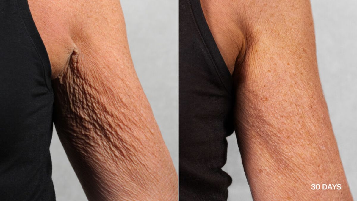 lyma laser pro results