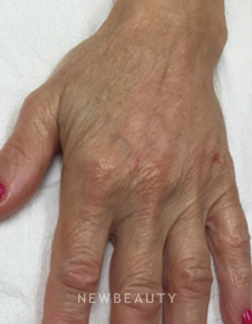 Dr. Kally Papantoniou - Radiesse - After