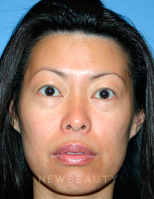 Dr. Kelly Bomer Injectables - Before