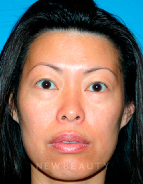 Dr. Kelly Bomer Injectables - Before