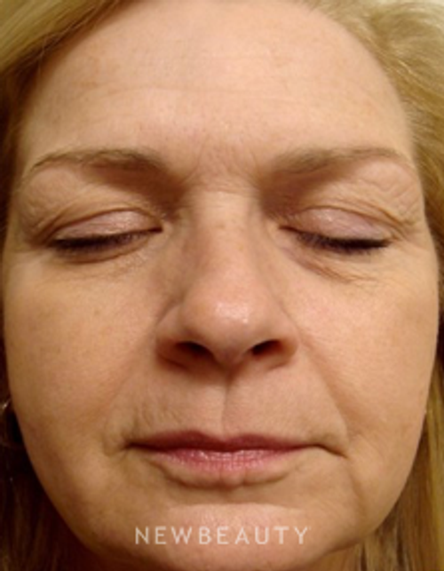 Dr. Doris Day - Botox - After