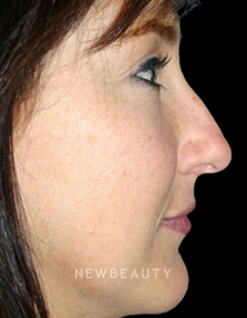 Dr. Kelly Bomer Rhinoplasty - Before