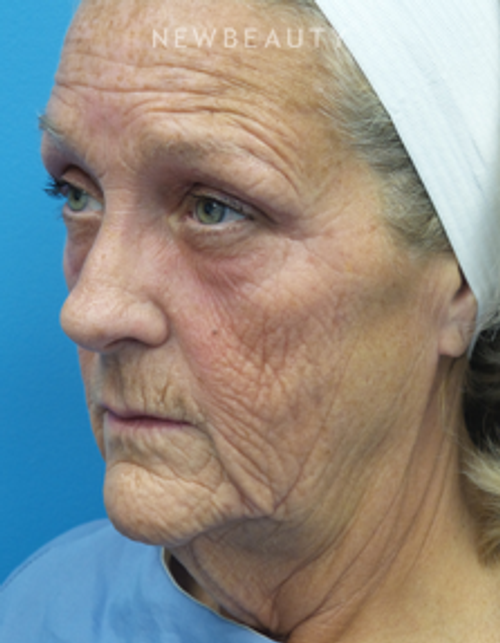 Dr. Christine Hamori - Full Facelift - Before