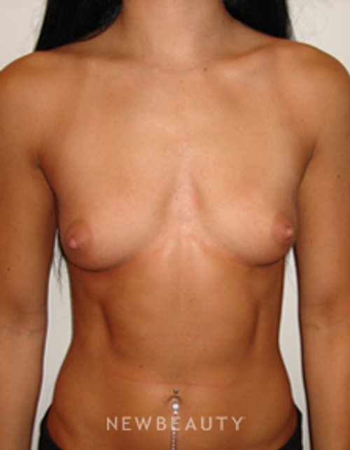 Dr. Michael Horn Breast Augmentation - Before