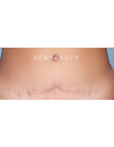 Dr. Sean Simon - Lasers - After