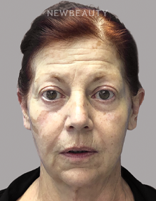 Dr. Paul Afrooz - Full-Face Rejuvenation - Before