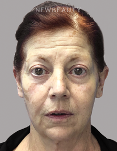 Dr. Paul Afrooz - Full-Face Rejuvenation - Before