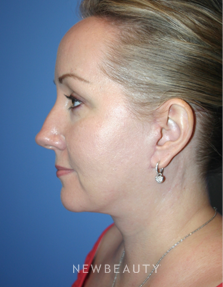 Dr. Kelly Bomer - Facelift - After